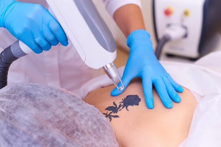 Как проходит процедура лазерного удаления татуировки?